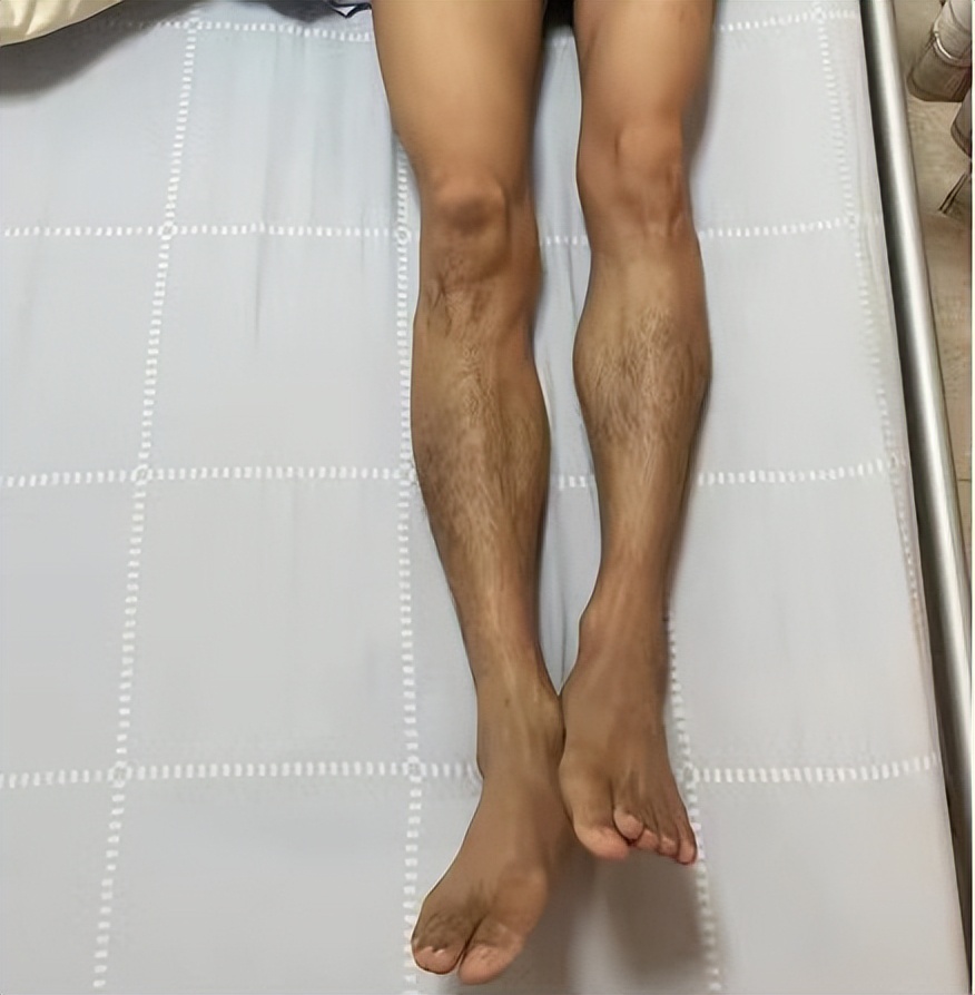 The infection left behind sequelae at a young age, and the 35-year pain ...