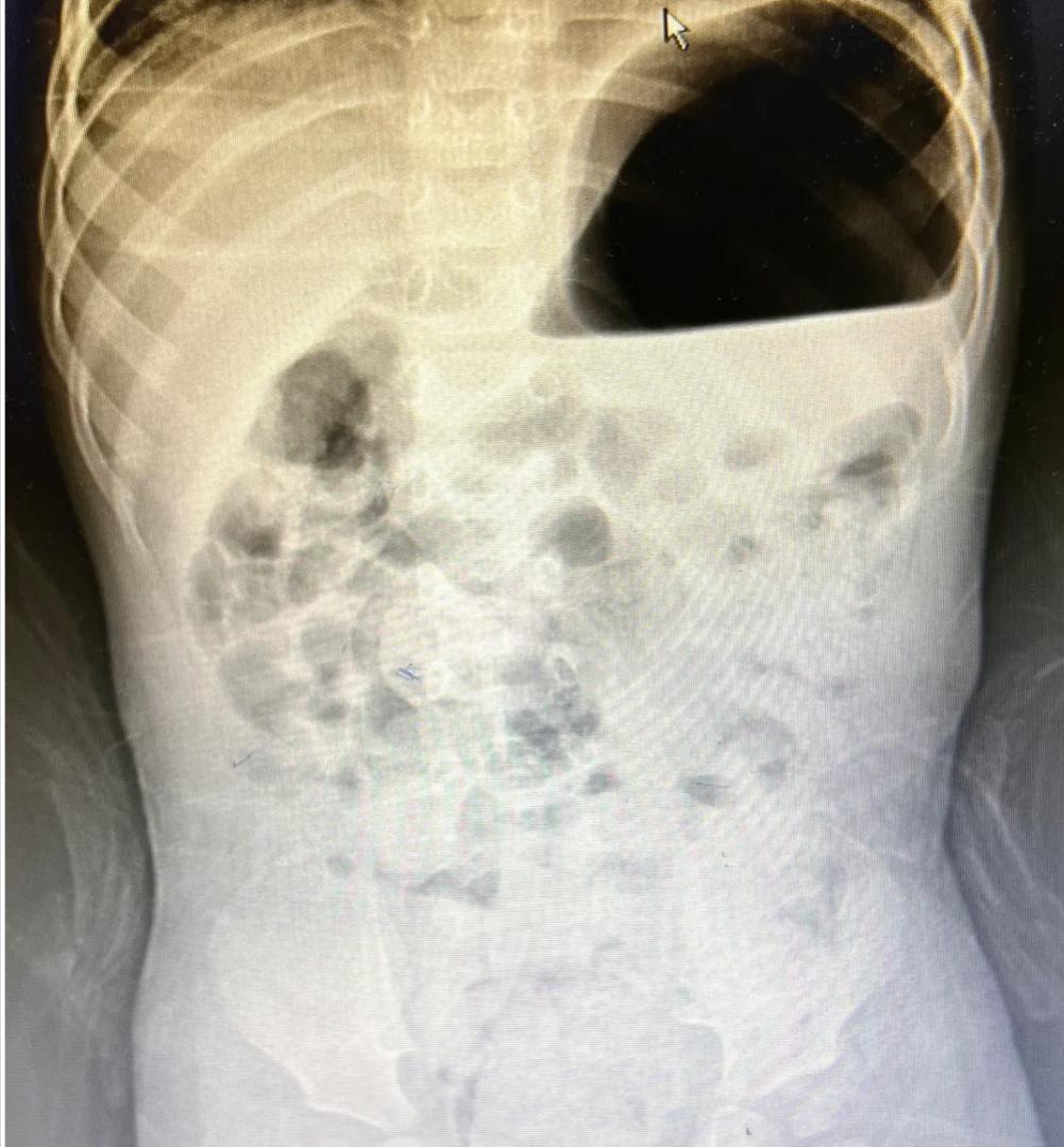 The baby does not gain weight and chronic constipation, is it really