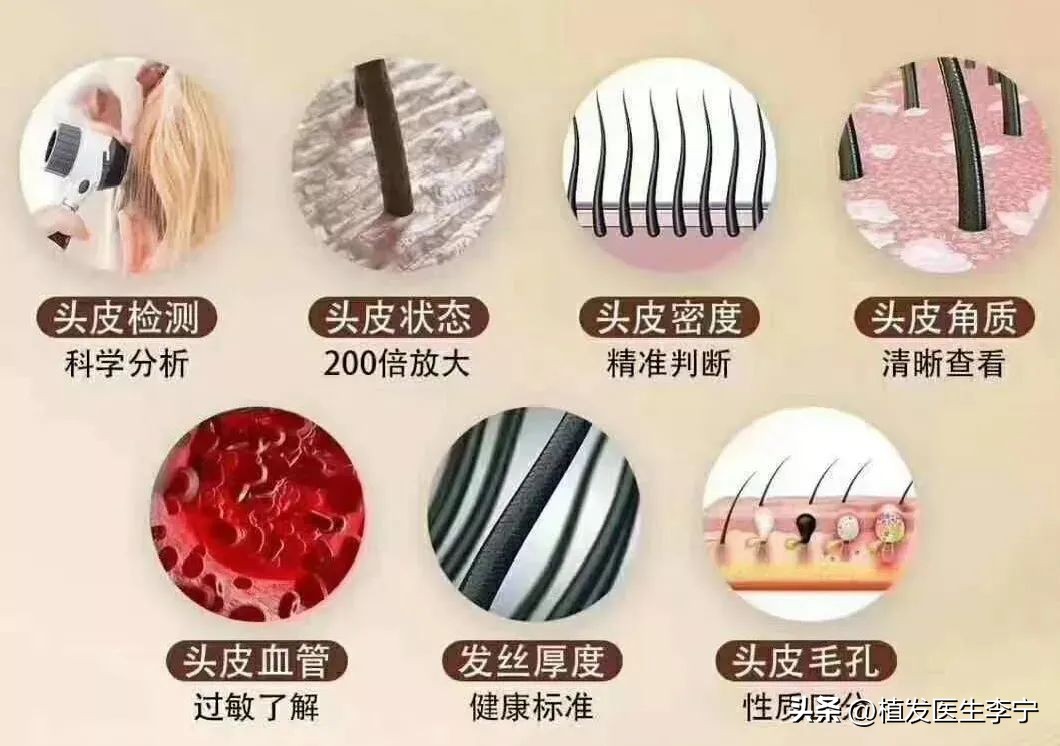 Does hair loss help?Hair follicle detection at a glance!Dr. Li Ning