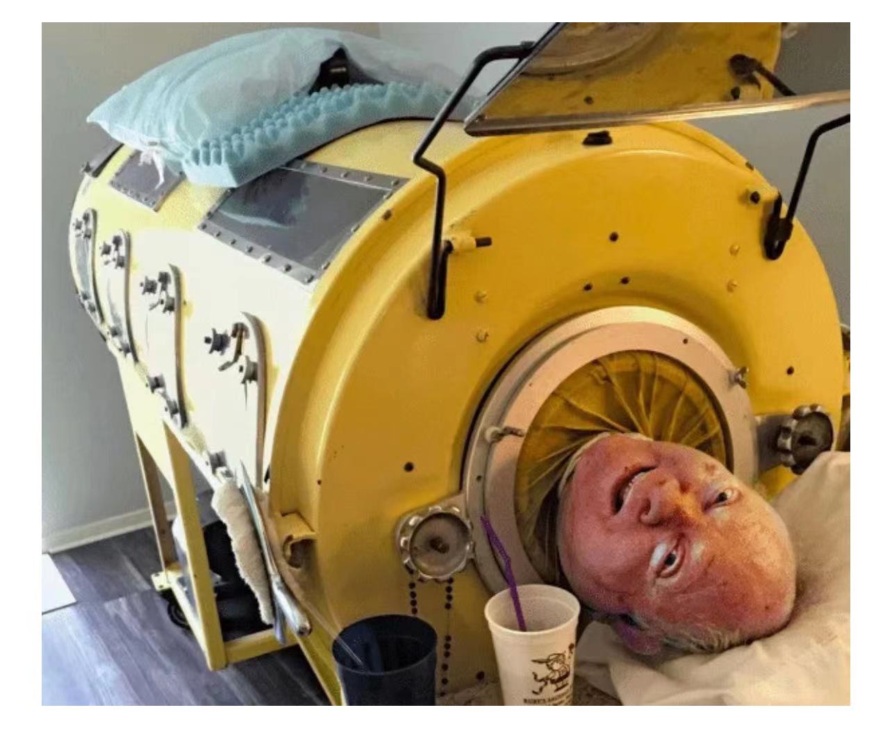 Strange anecdote: The iron lung man trapped in the 