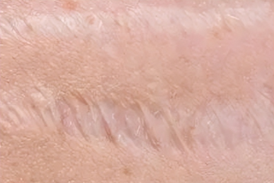 How to solve the scar? Can old scars be repaired? iMedia