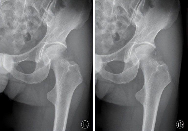 Understanding Calcific Tendonitis Perihip - iMedia