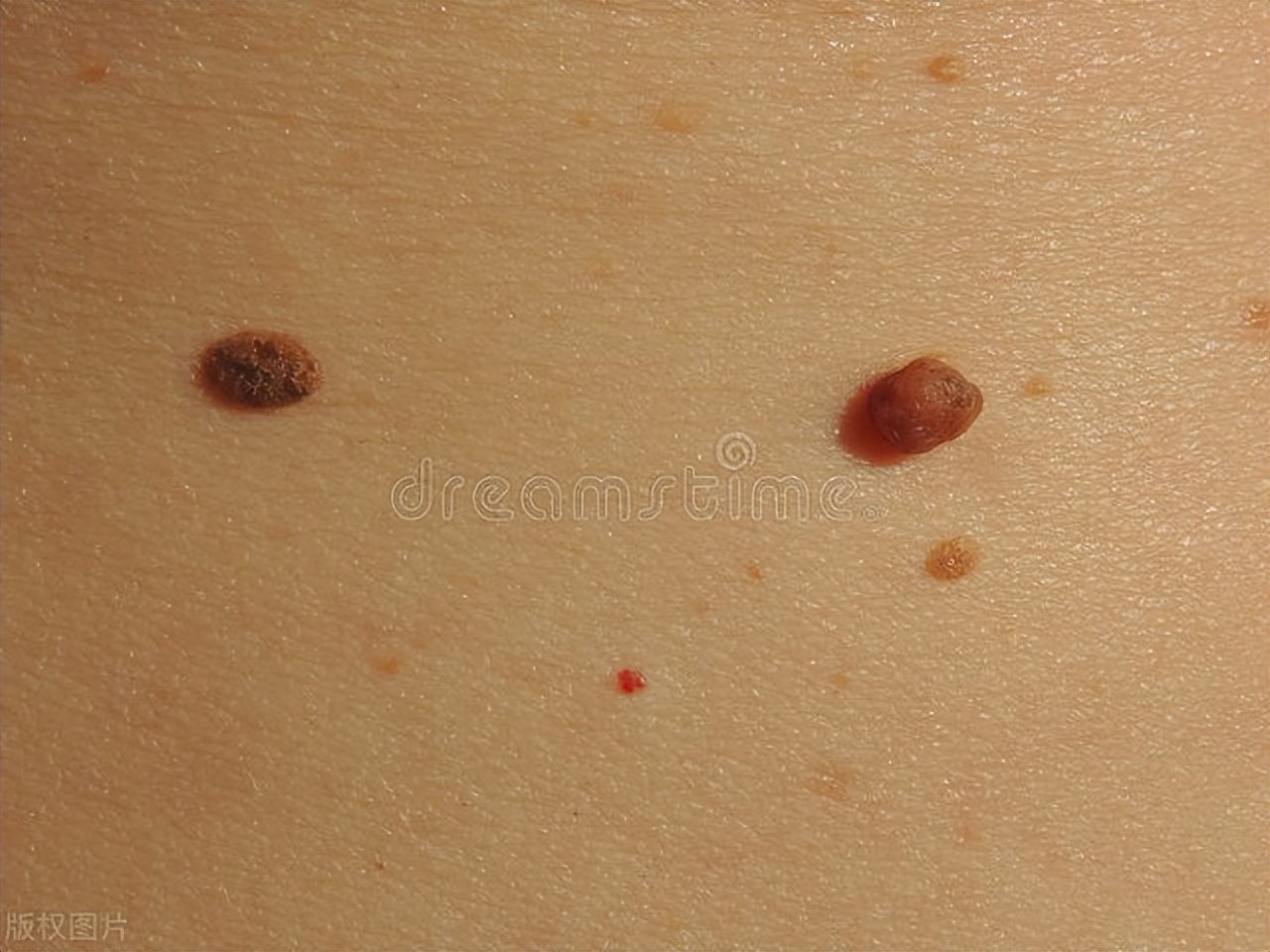 Difference between strawberry hemangioma and cavernous hemangioma iMedia