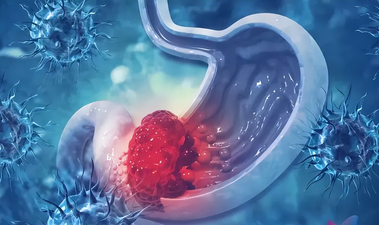 Stomach cancer does not itch or hurt? If there are 5 abnormalities