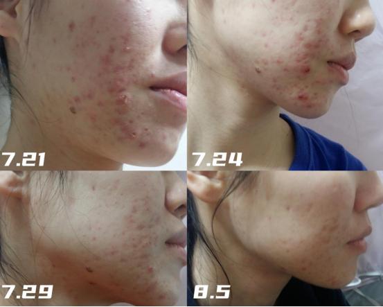 The face is full of pimples and pimples, which are all eliminated in ...