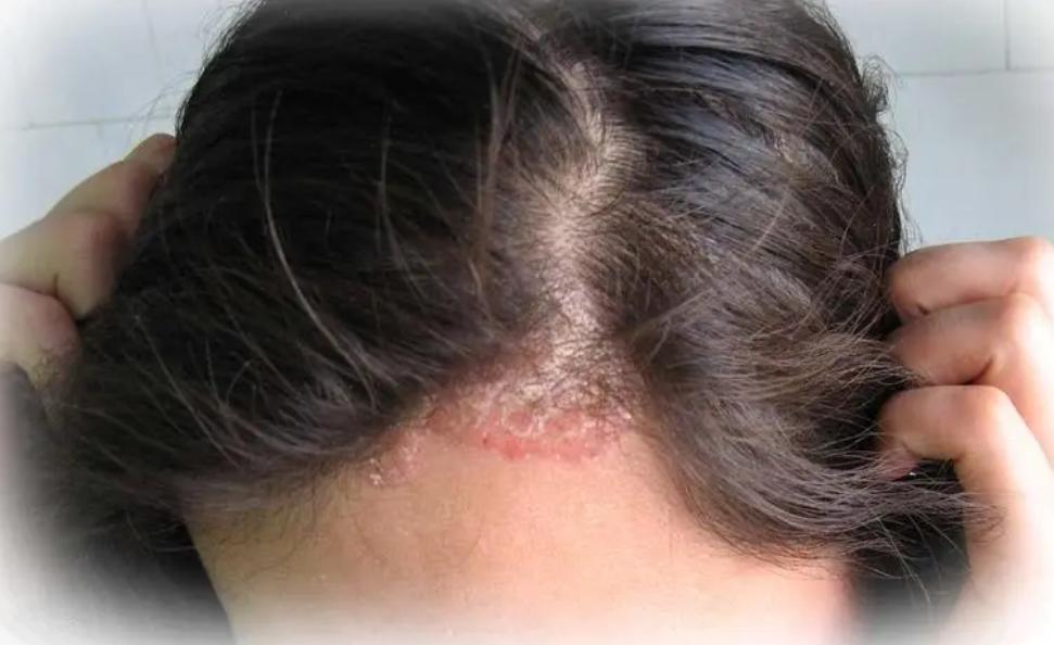 Why do pustules and pimples grow on the scalp?The doctor reminds: 3 ...