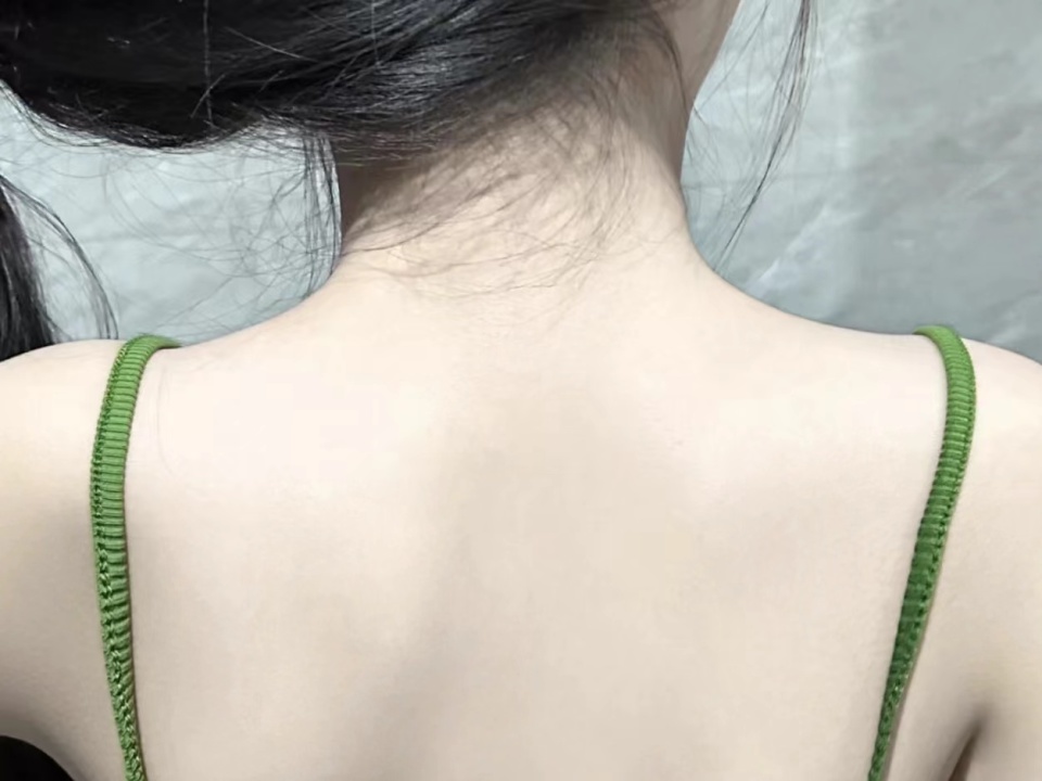 Picture of Back acne: How to see clearer skin - American Academy of Dermatology
