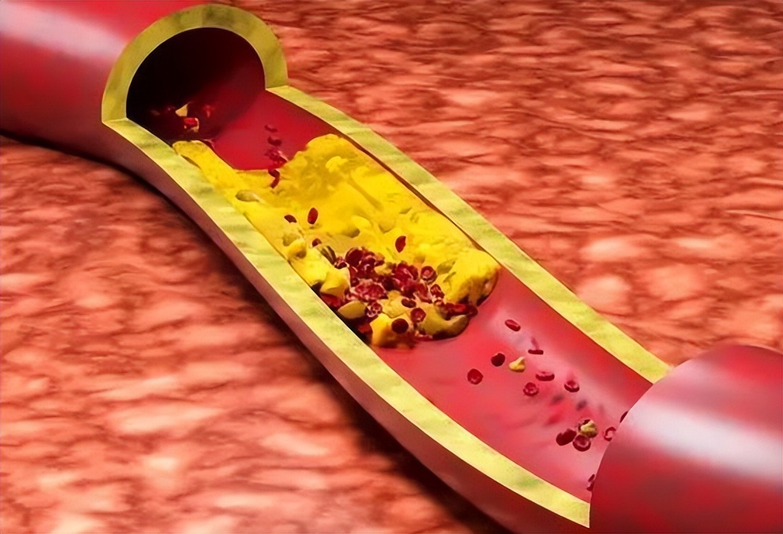 Can high blood pressure not eat walnuts?Doctor Patients with high