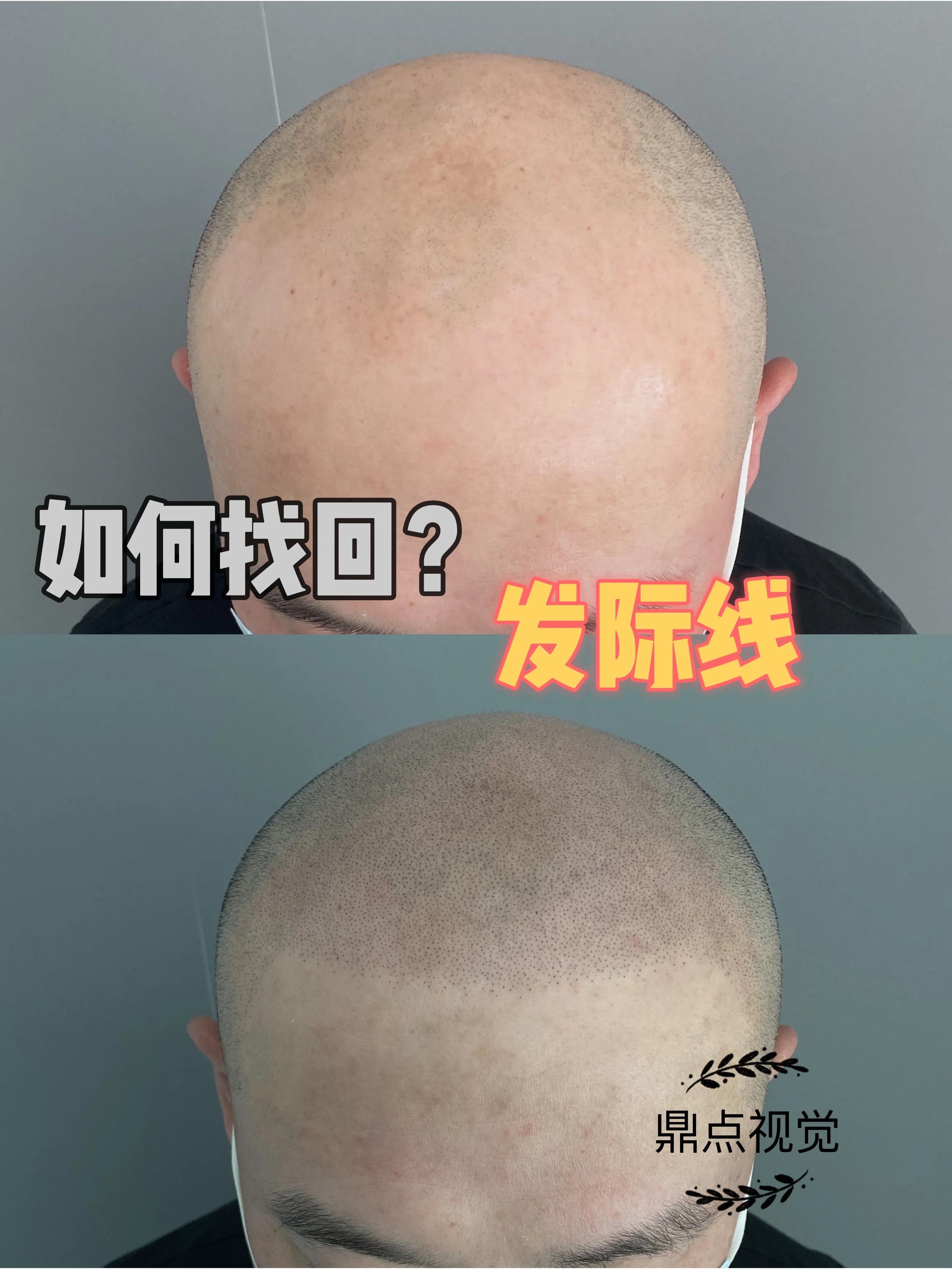 When dealing with hair loss, how to choose wig hair transplant? iNEWS