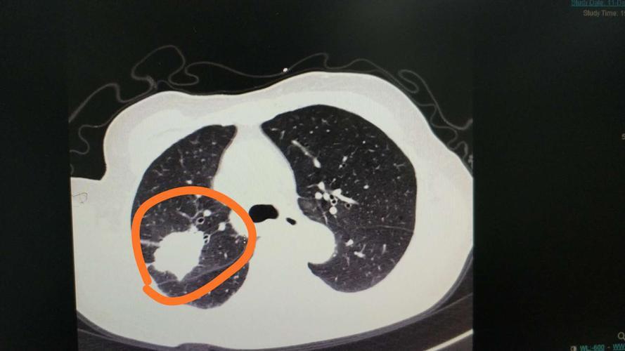 Bad lungs, can't you eat "eggs"? Doctor's advice eat "4 whites" often