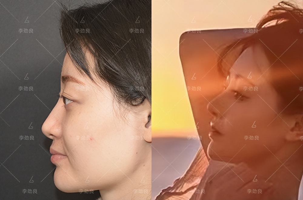 How long does the effect of ear cartilage rhinoplasty last? iNEWS