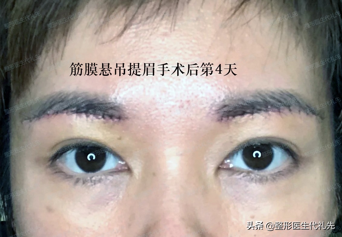 This is my fascial suspension brow lift before surgery 13 days after