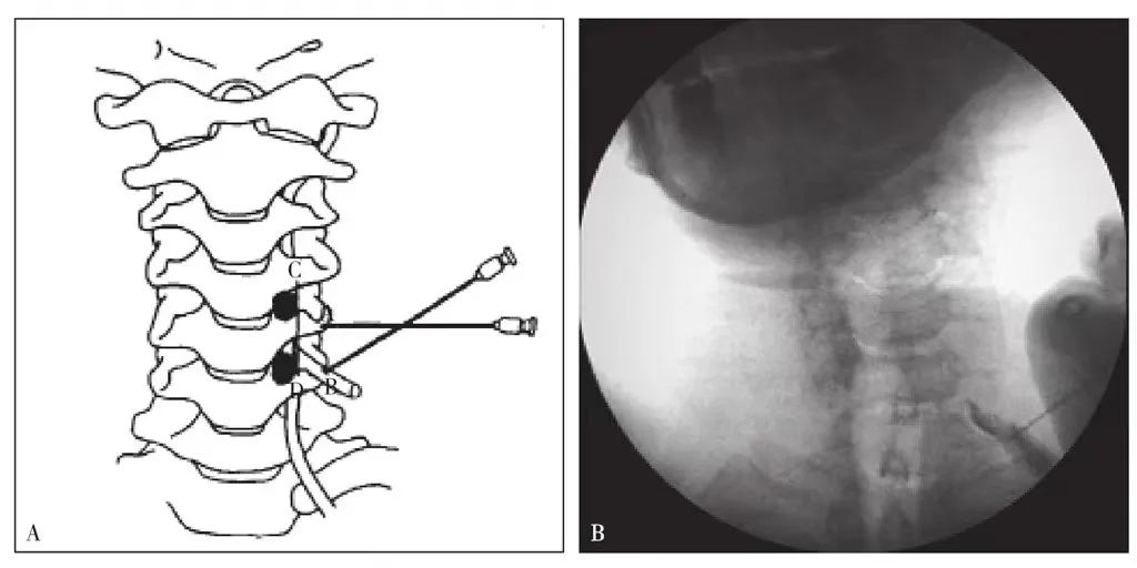 Supporting Block Radiology Selective radiculography and block - iNEWS
