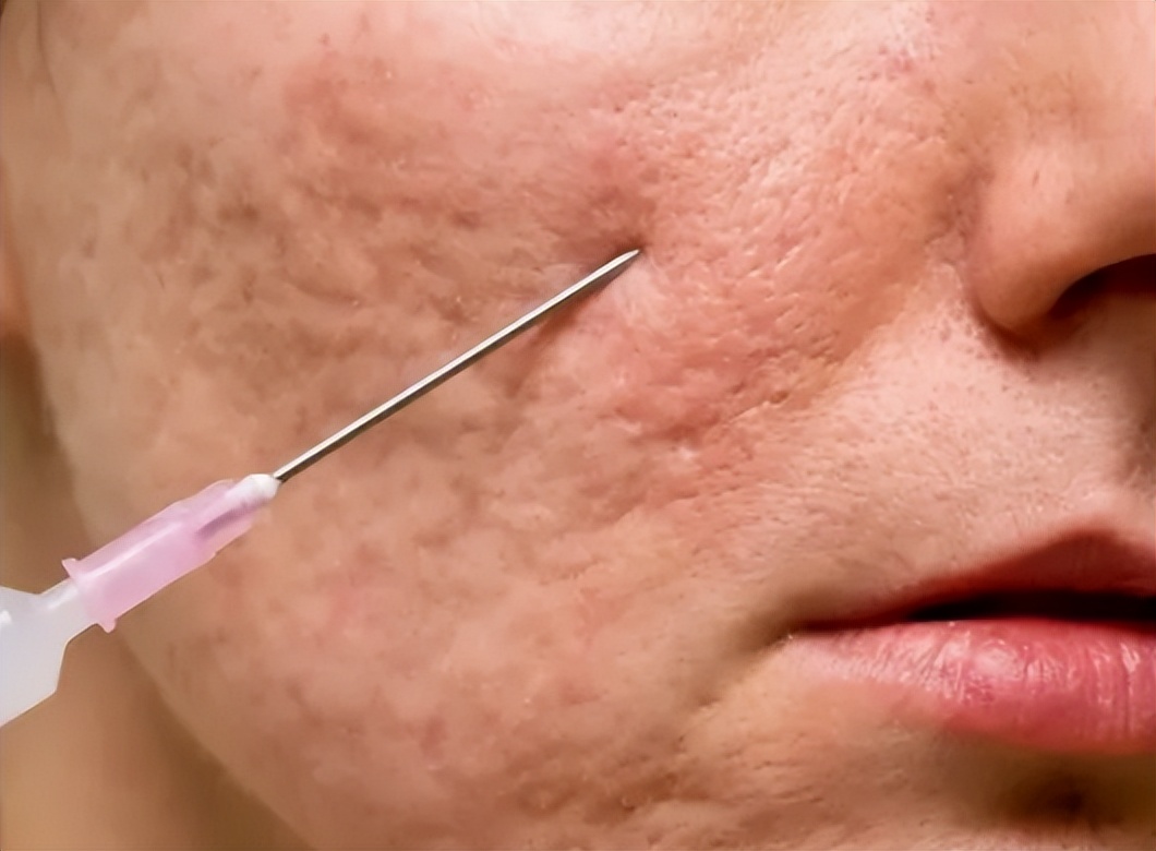 What should I pay attention to when I have a scar softening needle