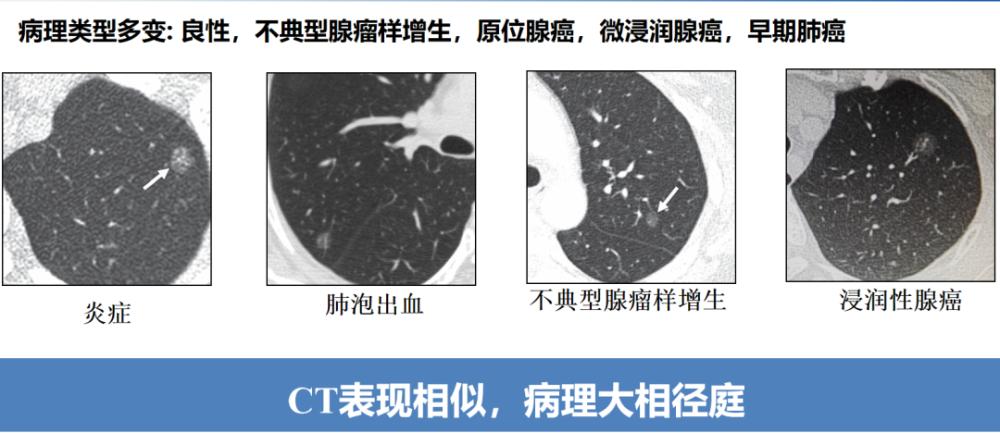 What kind of ground glass nodules is a precursor to lung cancer? - iNEWS