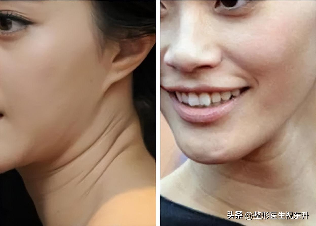 Neck lines are too deep, revealing age, the most effective way to