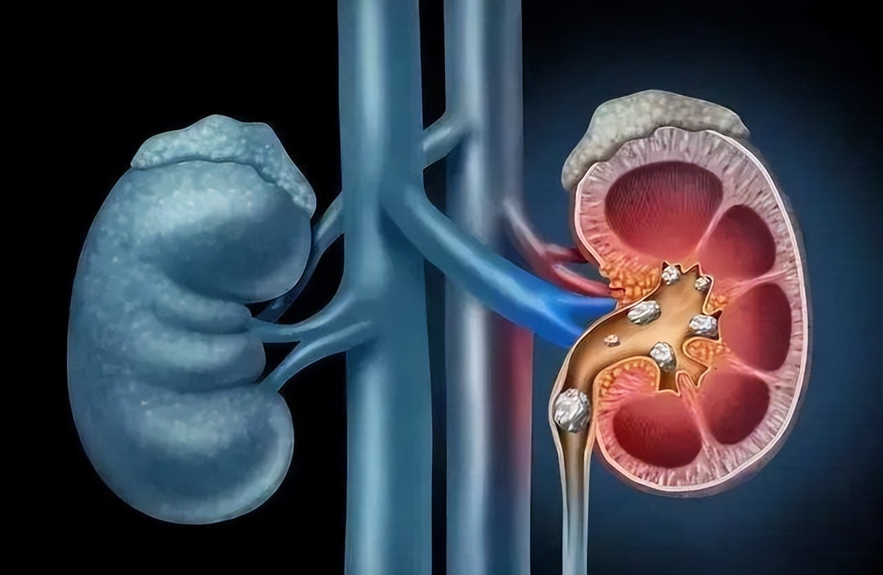 32yearold mother suffers from uremia and relies on dialysis to