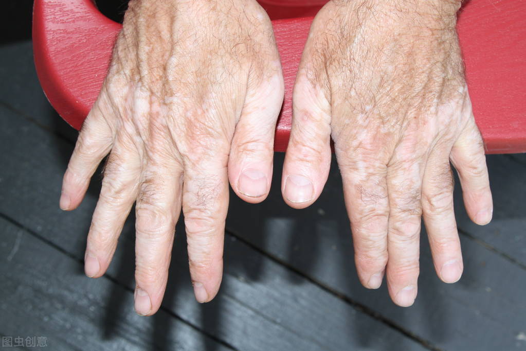 Why is vitiligo difficult to treat in the elderly? - iNEWS