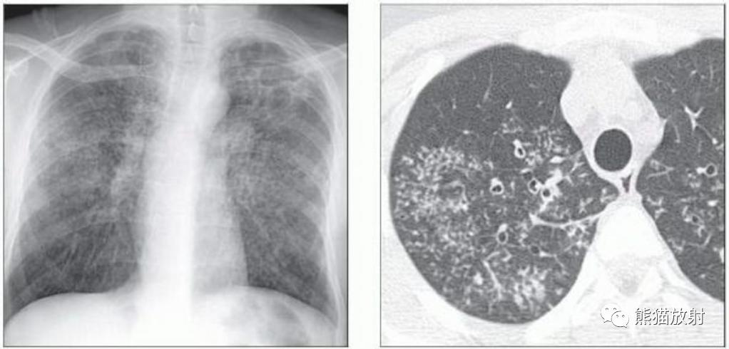 Tuberculosis, nontuberculous mycobacterial lung disease, mycoplasma ...