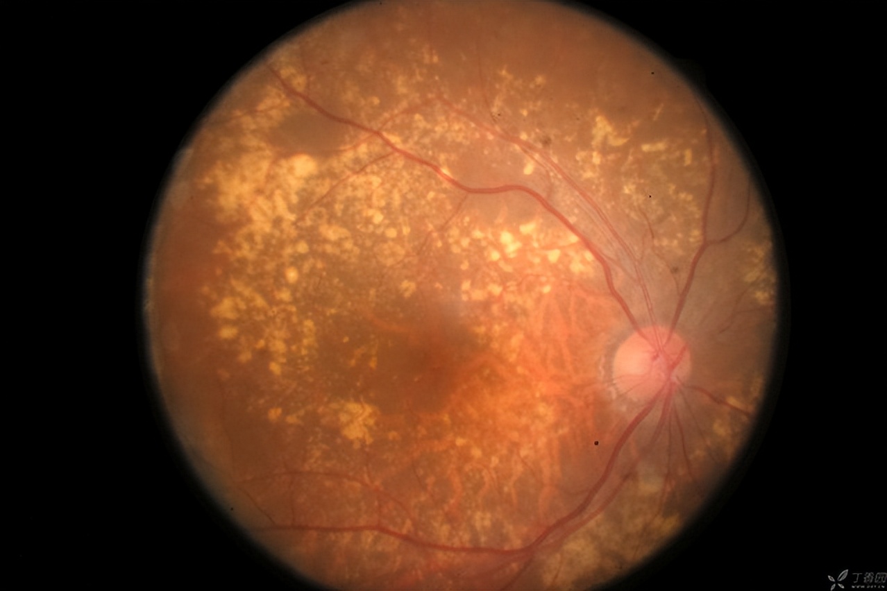 International Ophthalmology Express What should you eat to prevent age