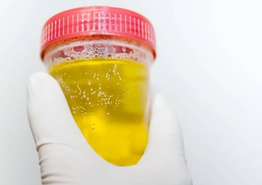 Elevated blood sugar, can you tell by looking at urine? There are 3
