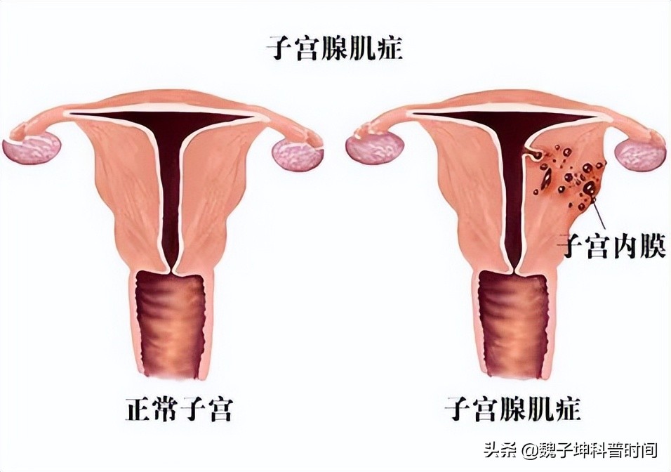 Can I still get pregnant if my uterine lining gets lost? iNEWS