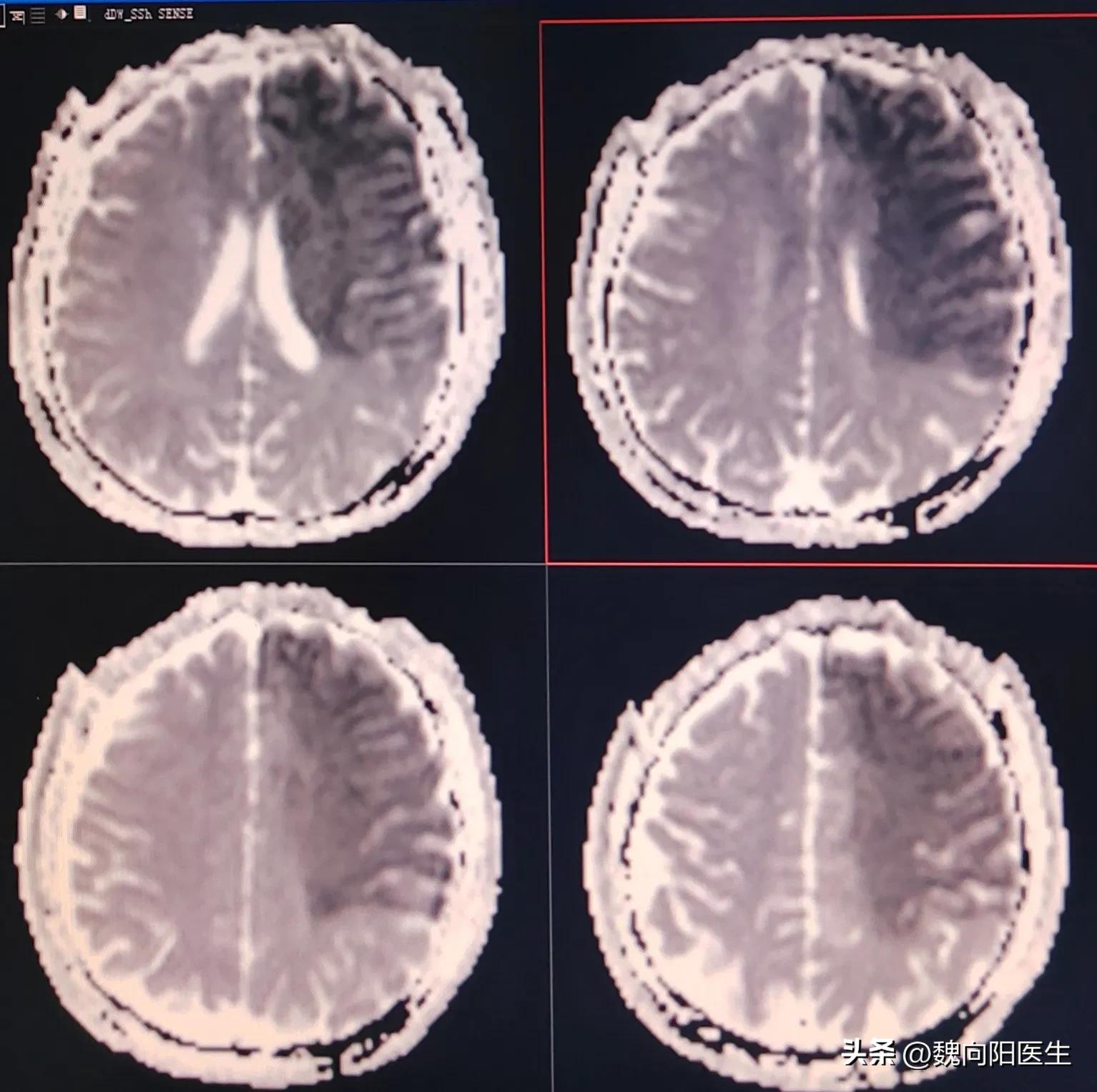 A 43 Year Old Man Who Was Treated After Acute Massive Cerebral Infarction Cerebral Thrombosis 8714