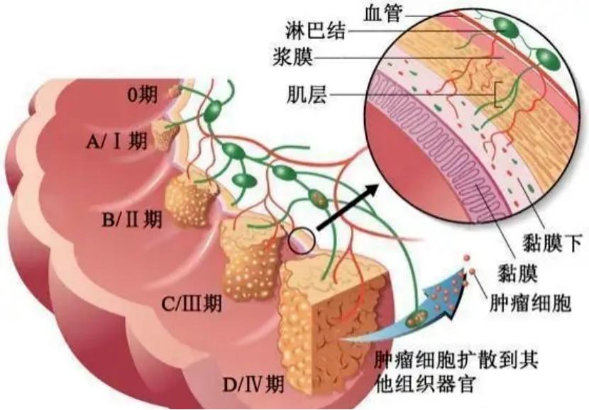 can-bowel-cancer-be-cured-if-it-recurs-can-many-return-to-normal-life