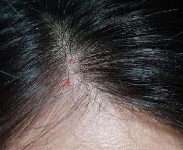 Why Does The Scalp Always Grow Pustules And Pimplesmay Be Related To 4 Factors Inews