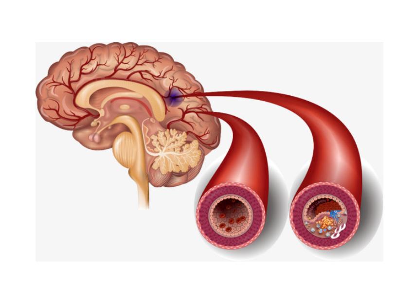 How does a cerebral infarction happen? How can I avoid cerebral ...