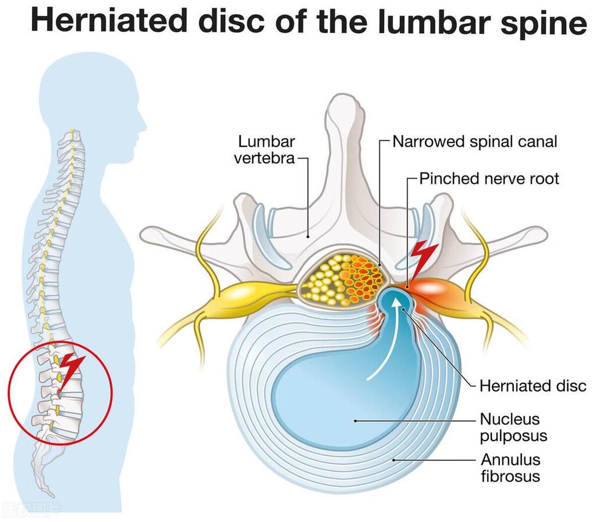 Minimally invasive interventional therapy for discogenic low back pain ...