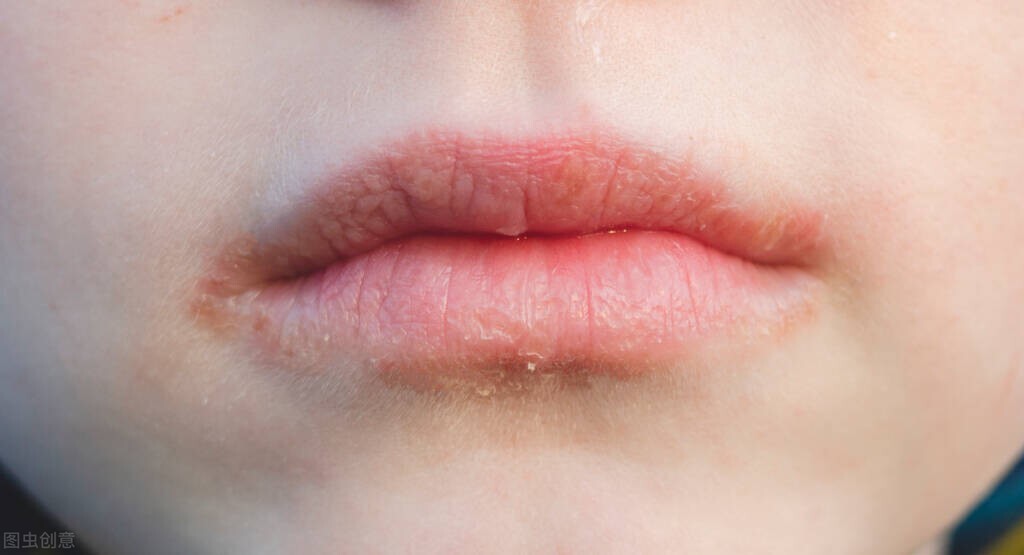 I have cheilitis and it is very painful, teach you a few tricks to deal ...