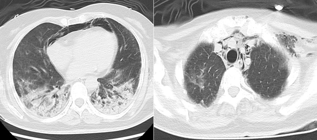 Diffuse ground-glass opacities in both lungs are still unresolved, and ...