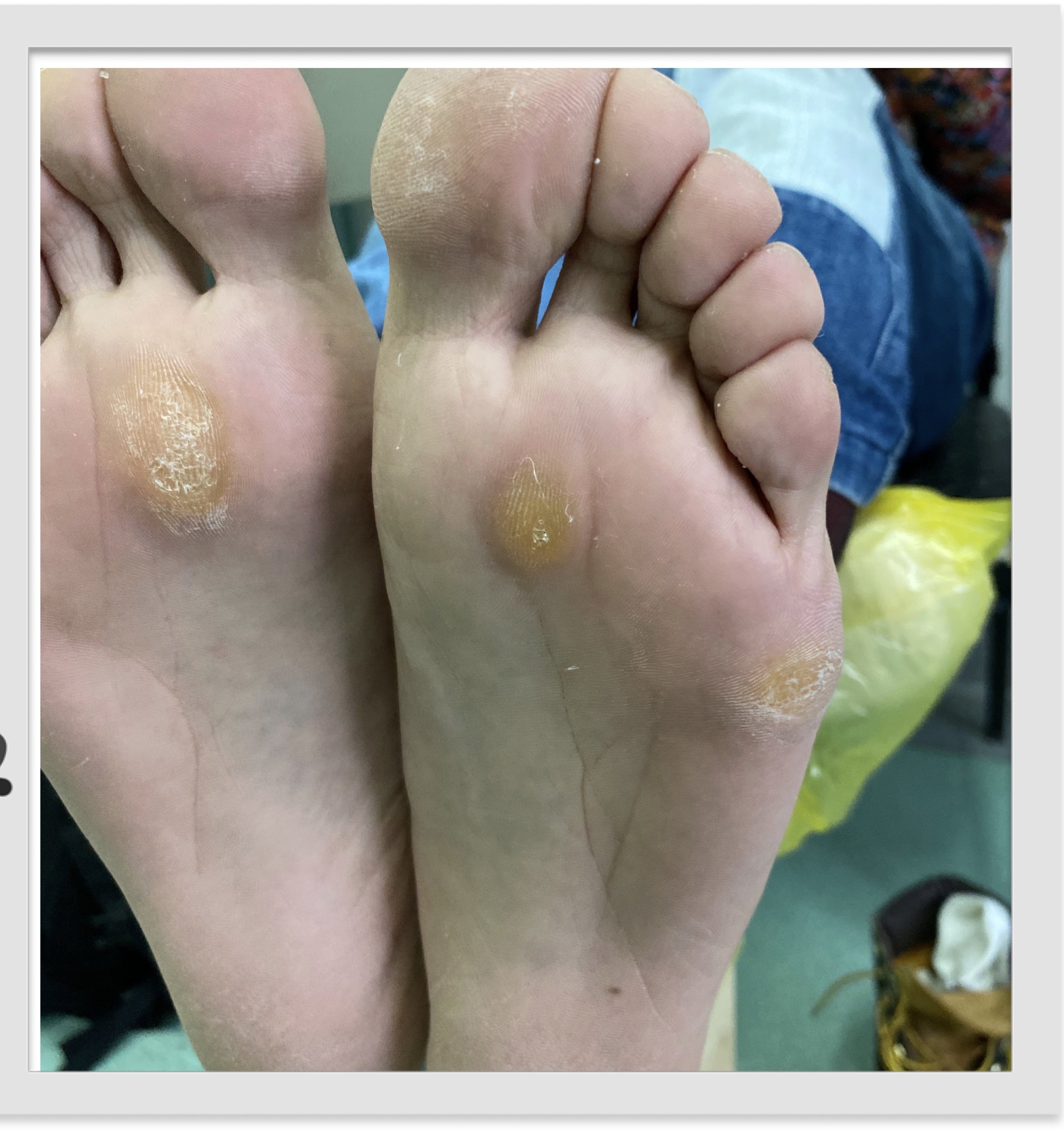 Bone Callouses What is the cause of pain in the big foot bone when walking and ...