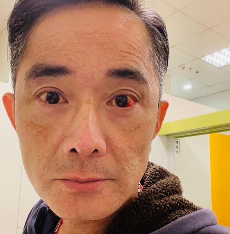 The 54-year-old actors microvessels ruptured and he bleeds 3 time photo