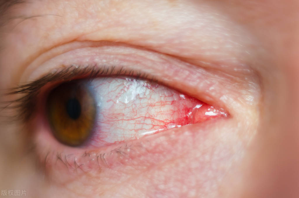 Can catarrhal conjunctivitis heal on its own? How to treat it? iMedia