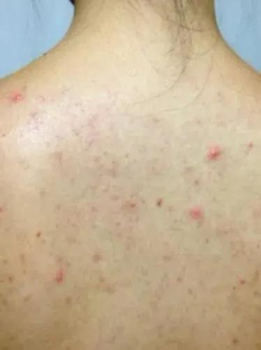 why-do-i-always-get-pimples-on-my-back-inews