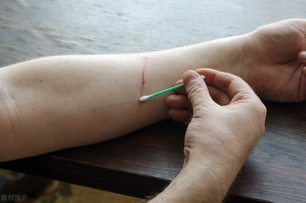 What should I do if I was scratched by a cat? iNEWS