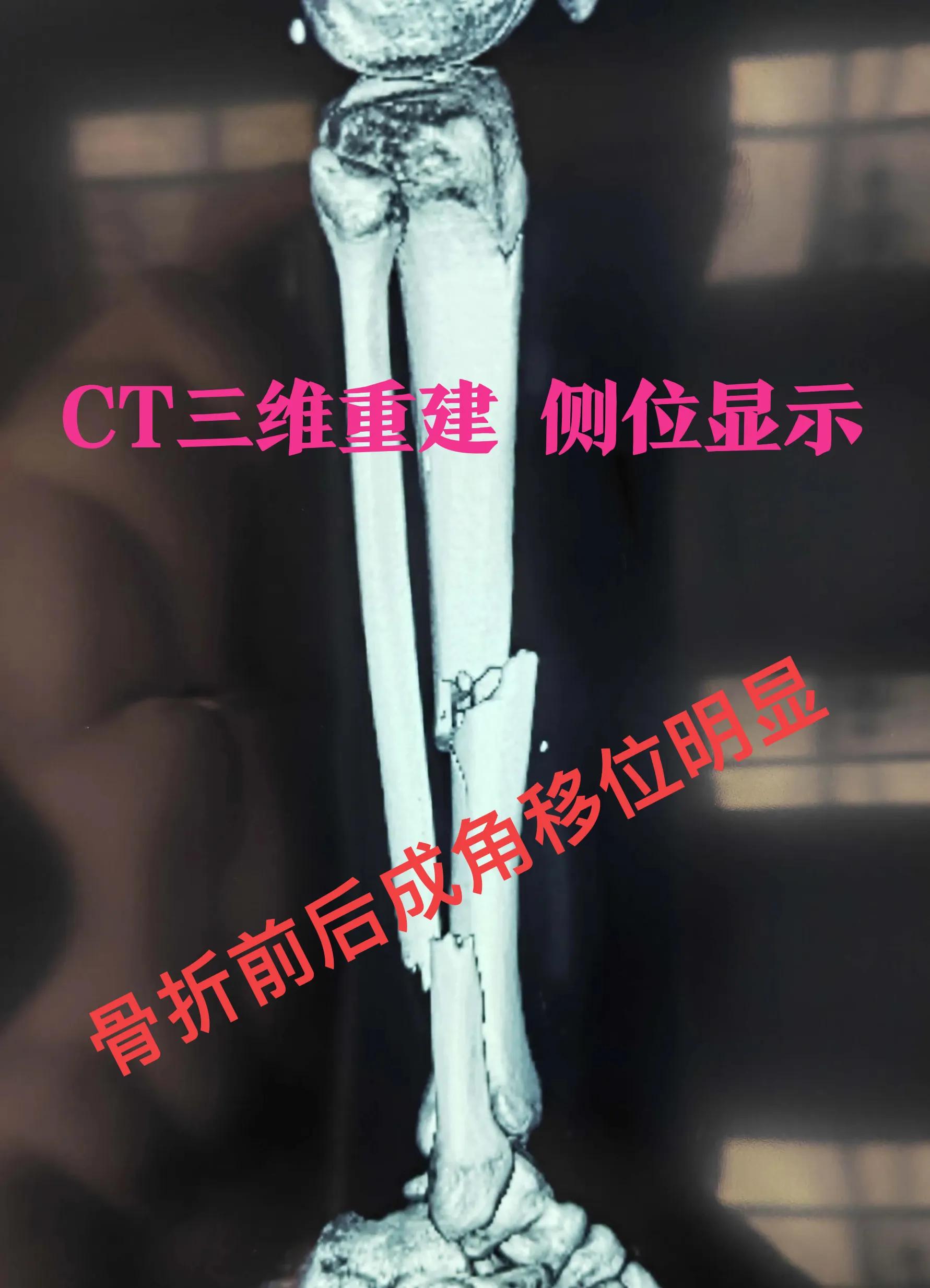 Orthopedics - double fracture fixation of open tibia and fibula ...