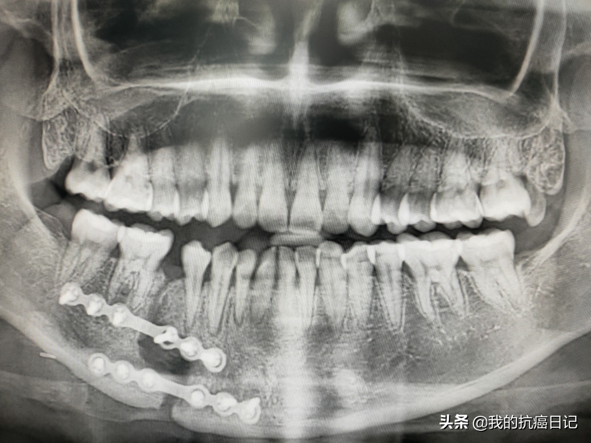 Tongue cancer girl A year after opening my jaw, I still have a big crack in my jaw iNEWS