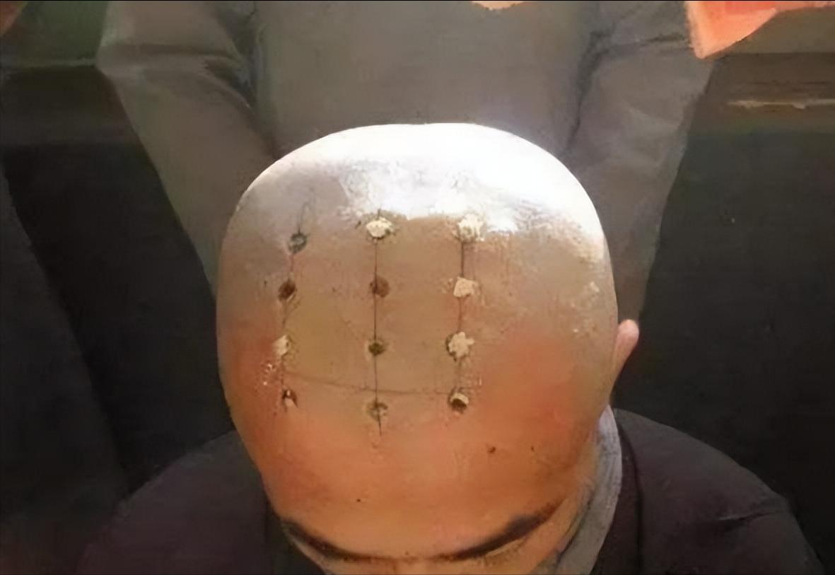 What does the dot on the monk's head mean?How did it burn? iNEWS