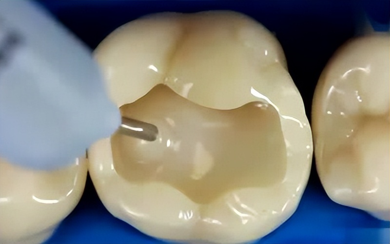 Why do I still have a toothache after a filling? iNEWS