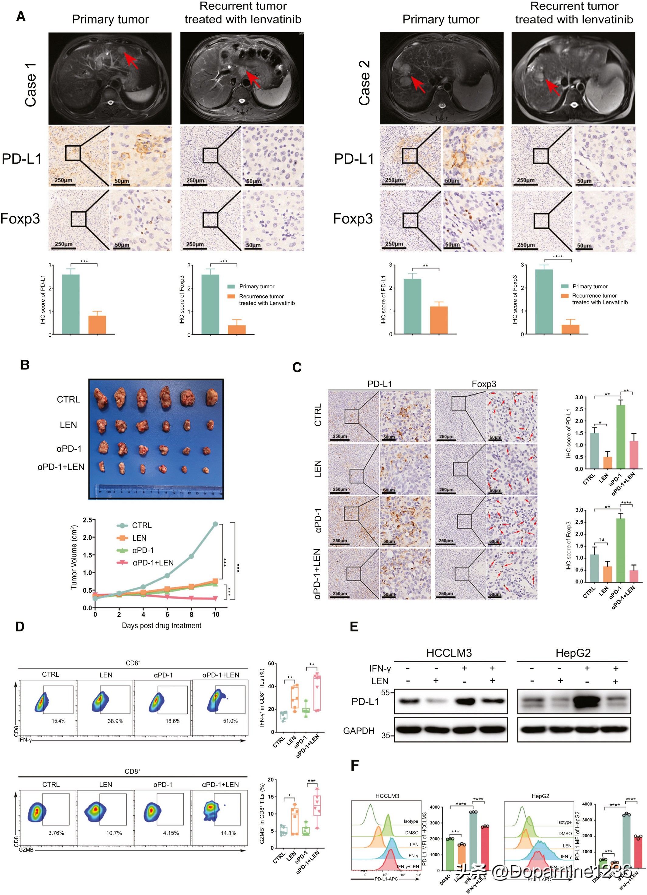 Lenvatinib enhances anti-PD-1 immune response in HCC by targeting FGFR4 ...