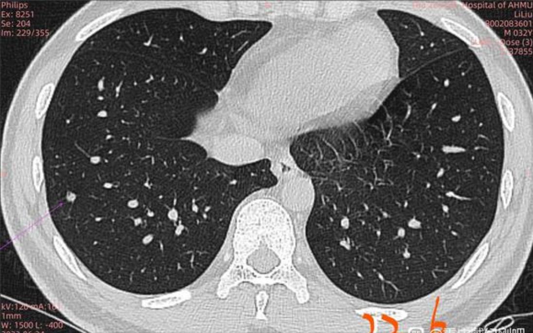 A solid nodule with ground glass component was determined to be ...
