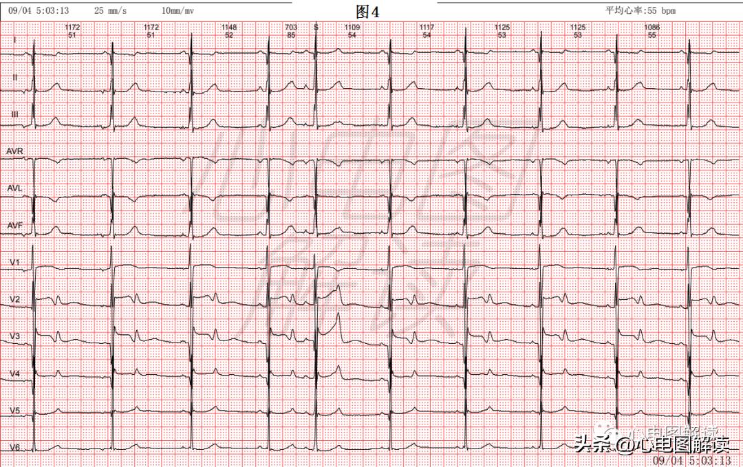 A Case Of Hypertrophic Cardiomyopathy - INEWS