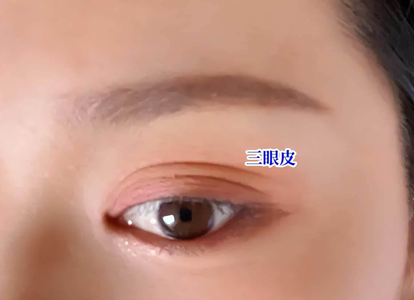 Why do double eyelids triple eyelids? iMedia