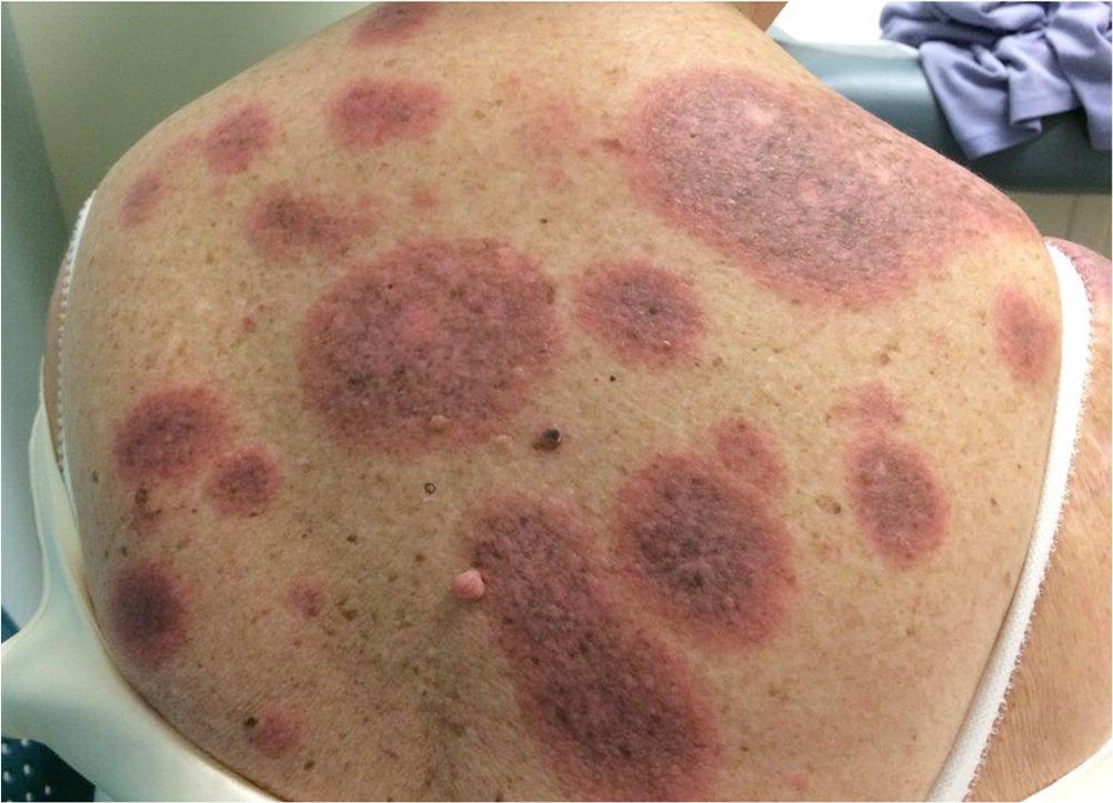 Circular Rash Tablets Not all red patches are eczema. - iNEWS
